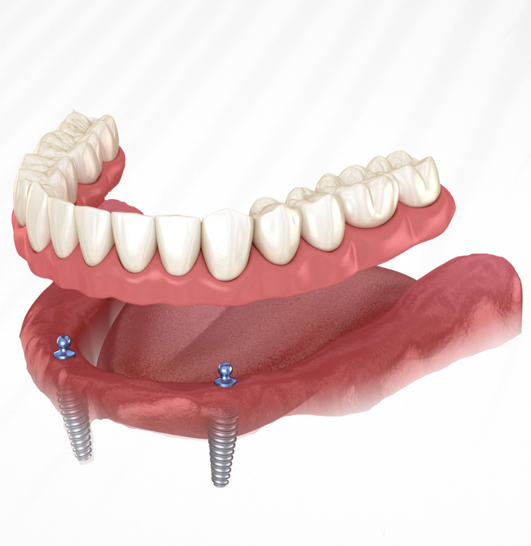 Dental Implant Image_01