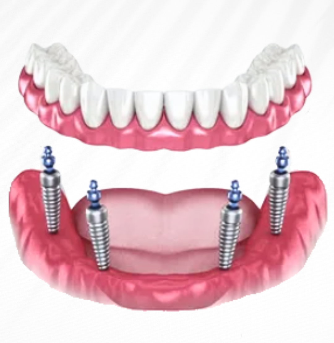 Dental Implant Image_02