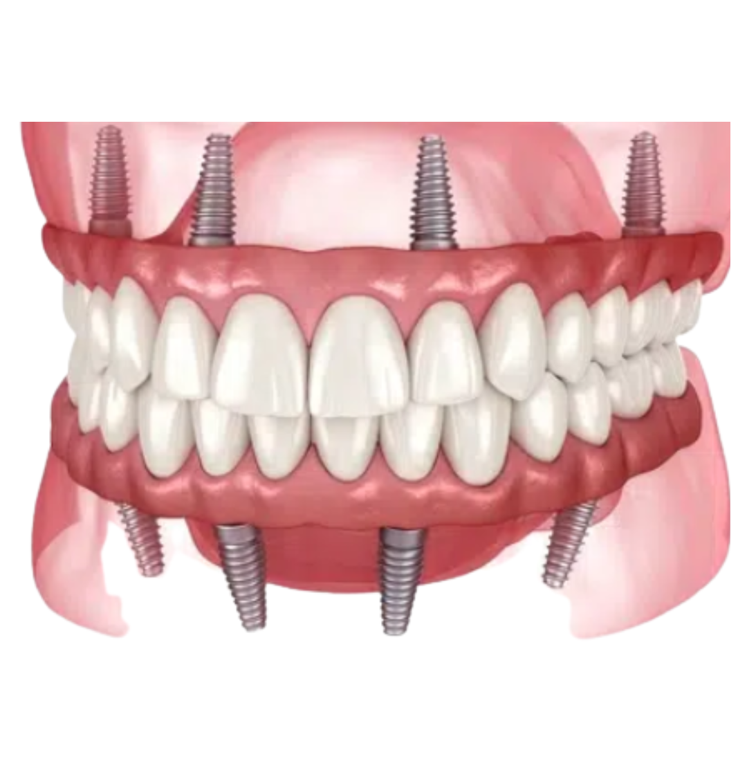Dental Implant Image_04