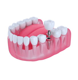 Single Implant