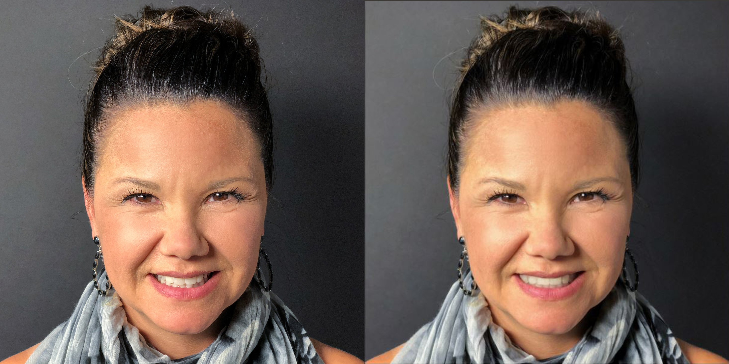 SmileView-BeforeAfter06Kym