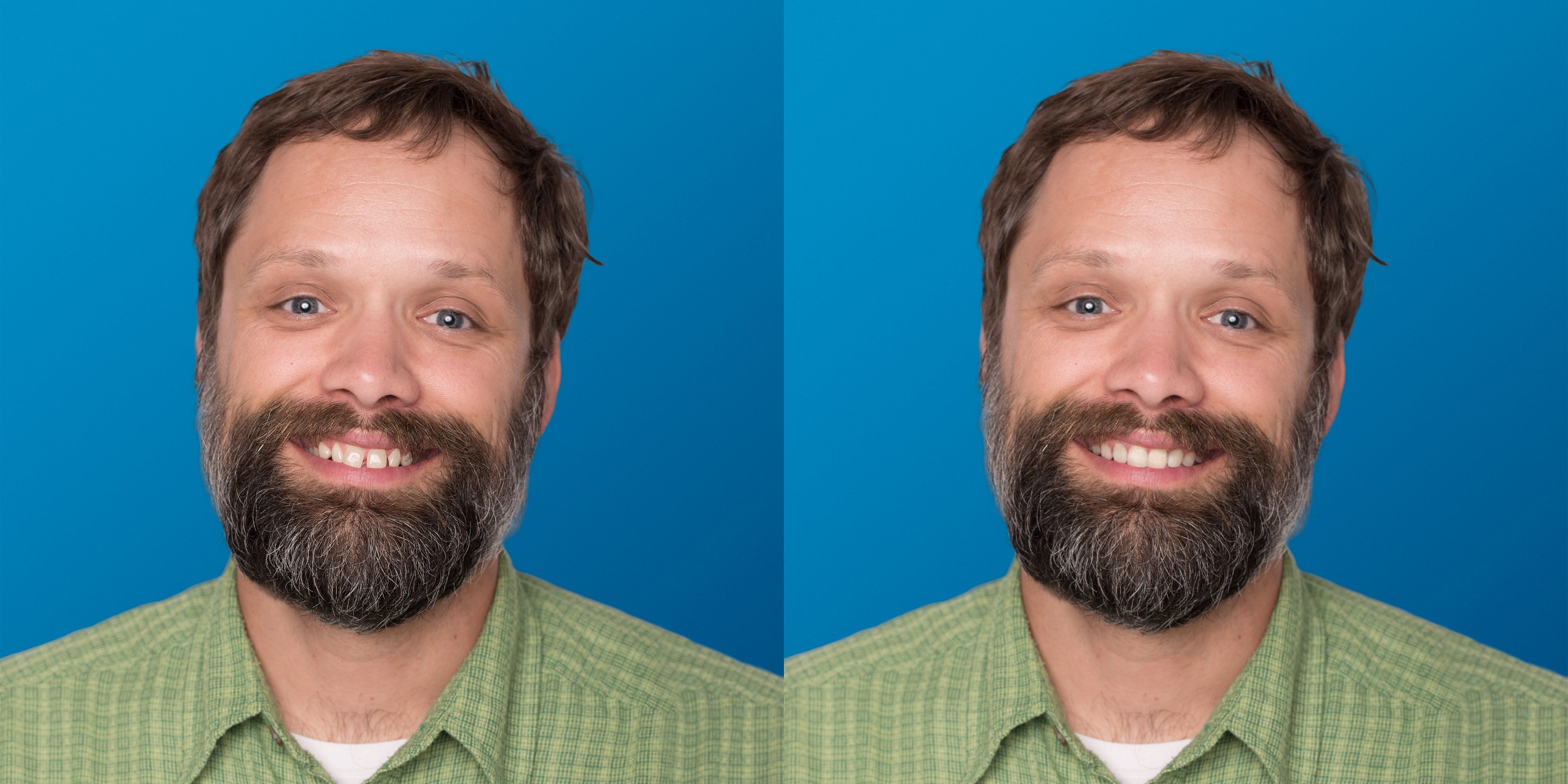 SmileView-BeforeAfter09Dan