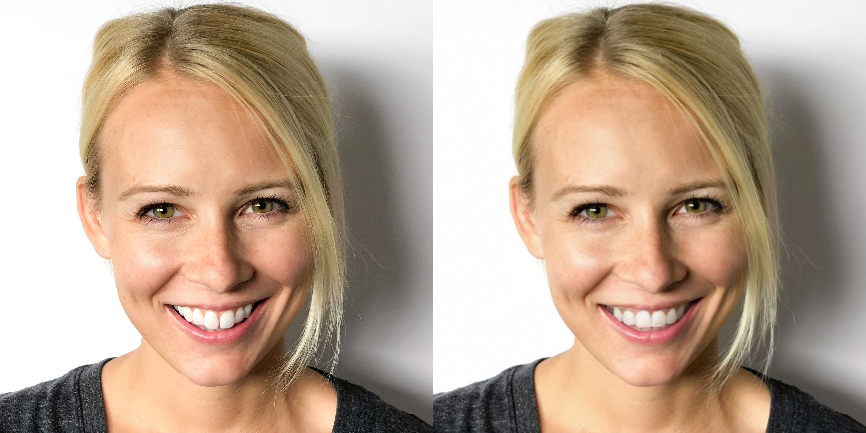 SmileView_BeforeAfter04Maggie